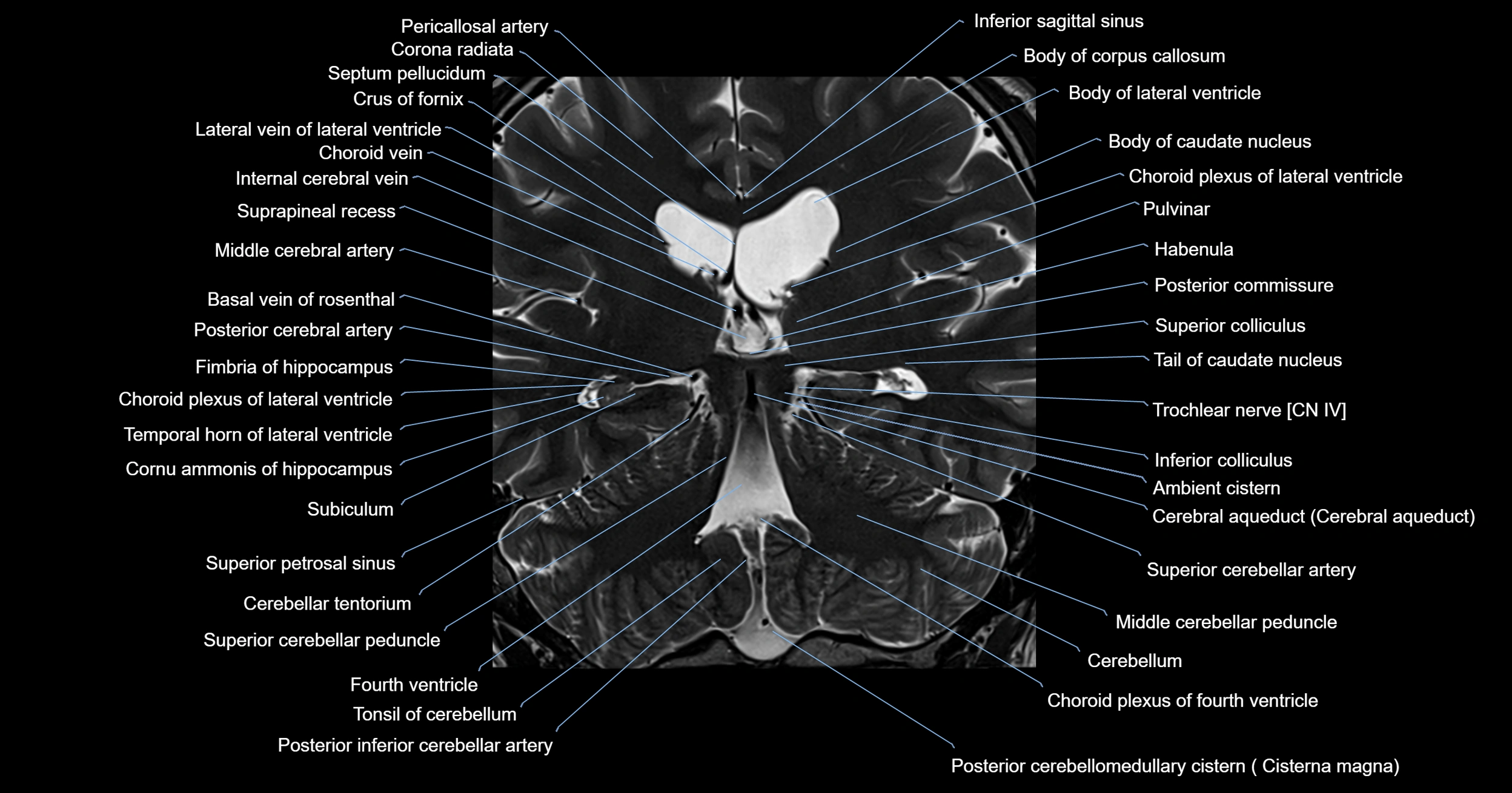 MRI brainstem & basal ganglia anatomy labelled 3T MRI images -img-00001-00029.webp